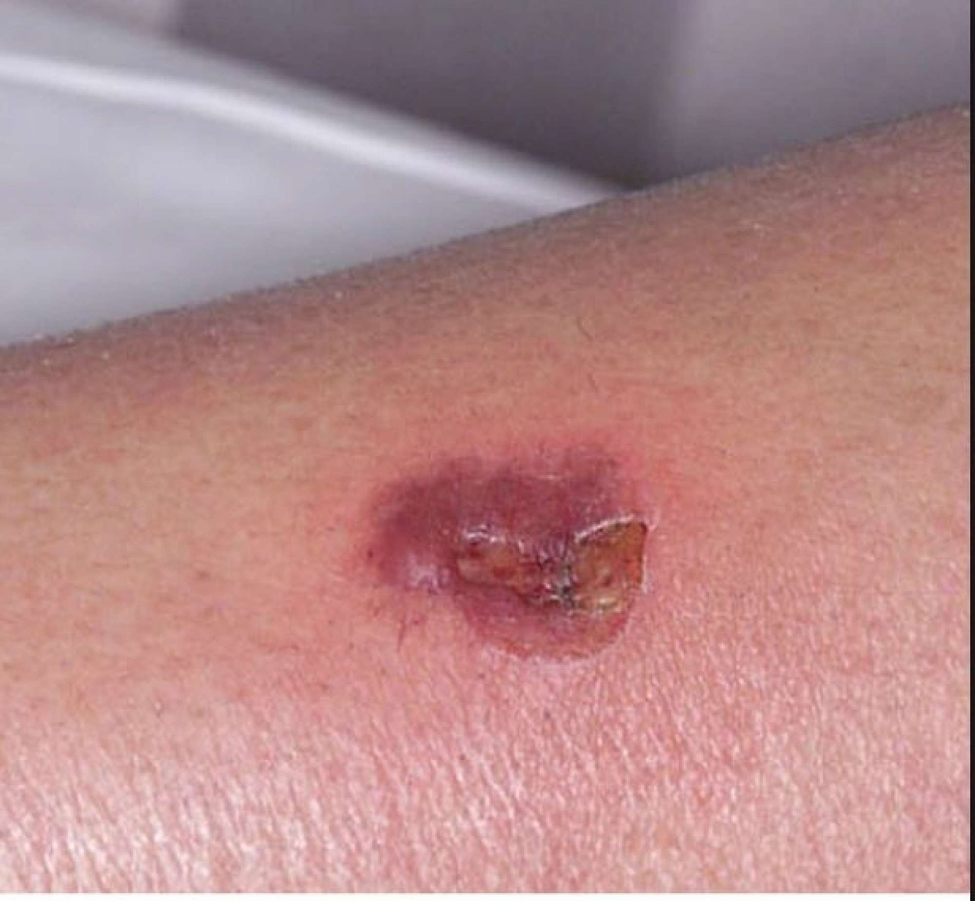 cigarette marks on skin healed burns concern] so I got burned with a cigarette.. is this healing badly? What can I do to help speed up the process? : Impetigo - School Sores
